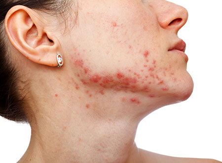 woman-acne-oral-infection.jpg