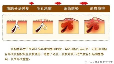 痤疮与性格、饮食、月经、作息的关系